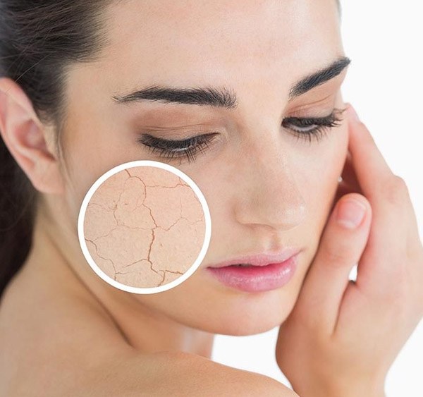 Da khô là yếu tố phổ biến làm tăng nguy cơ mắc bệnh chàm da, nhất là viêm da cơ địa